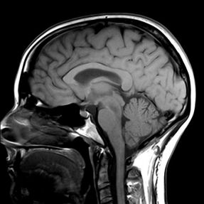 MRI of the Brain