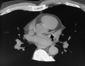 Normal Arteries