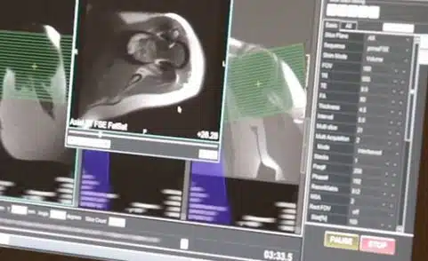 Is it Safe to Get an MRI with my Implant?